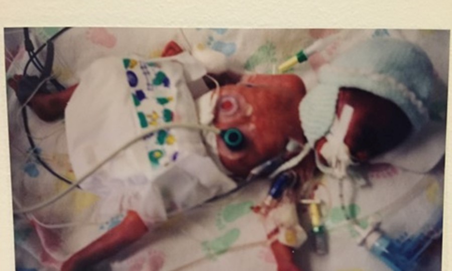Andy as a 1lb 15oz premature baby in hospital.  He has tubes coming out of him and his nappy is far too big.