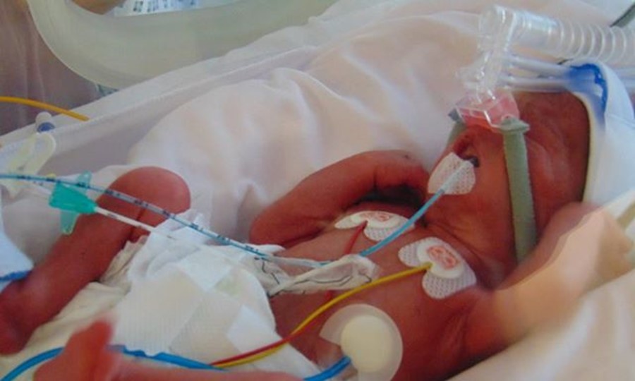 Wolfe as a tiny premature baby in an incubator, with tubes attached to him.