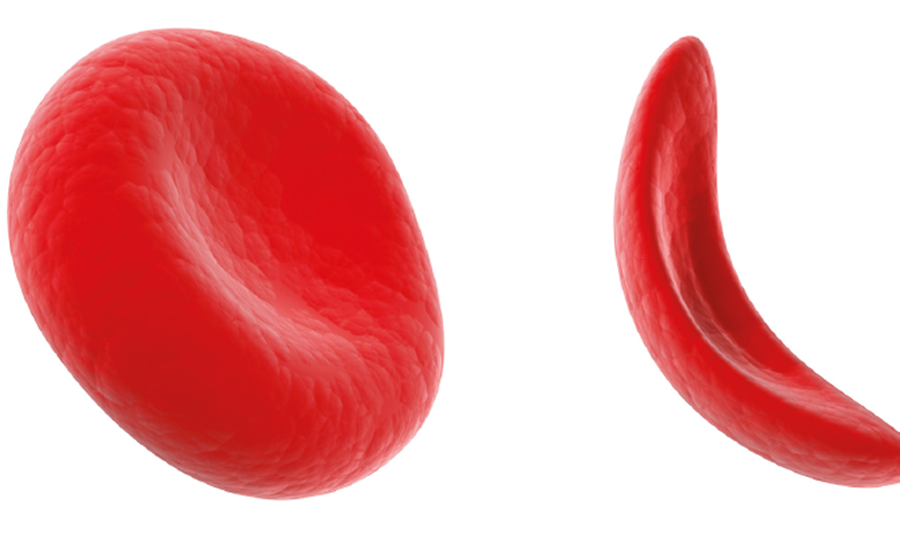 Normal round, plump, red blood cell on left and flat, thin, sickle cell on the right. 