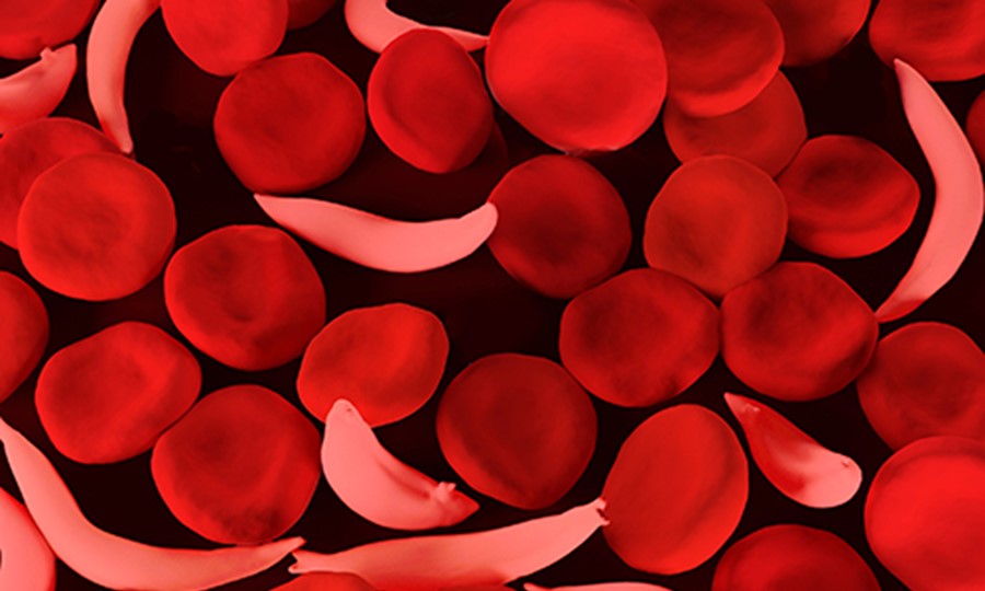 Image of disc shaped normal red blood cell alongside sickle shaped cell