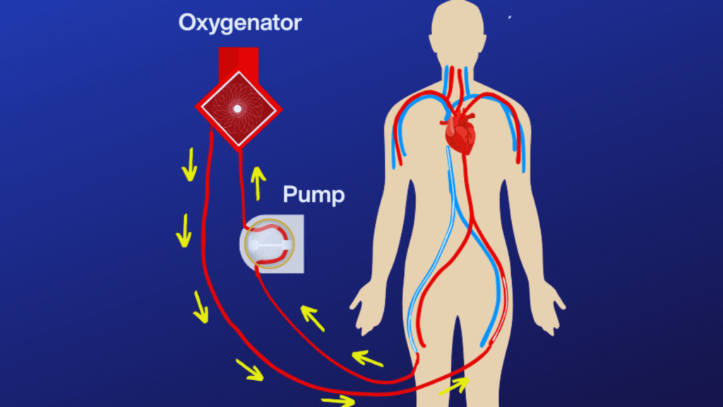 Graph showing how blood comes through a tube from the body through a pump to the oxygenator then back to the body.